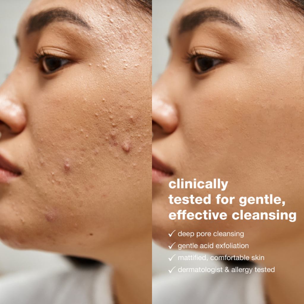 Tolpa Sebio+ AHA LHA Face Wash Gel 195ml | Acne Cleanser | Gentle Exfoliation